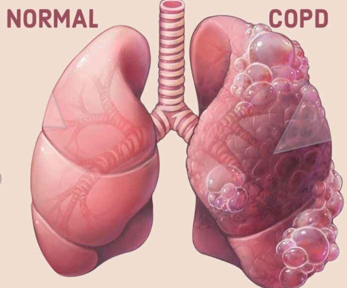 Top 10 Causes of Death in Humans around the World 2023